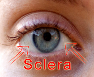 scleritis